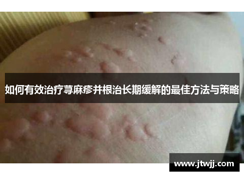如何有效治疗荨麻疹并根治长期缓解的最佳方法与策略